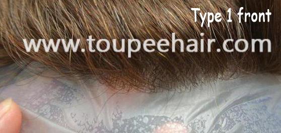 Type 1 v-looped invisible front hairline